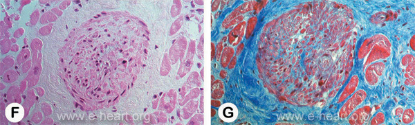 Intramural small coronary CAV